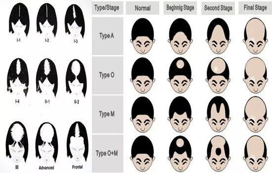 女性男性脱发类型对比