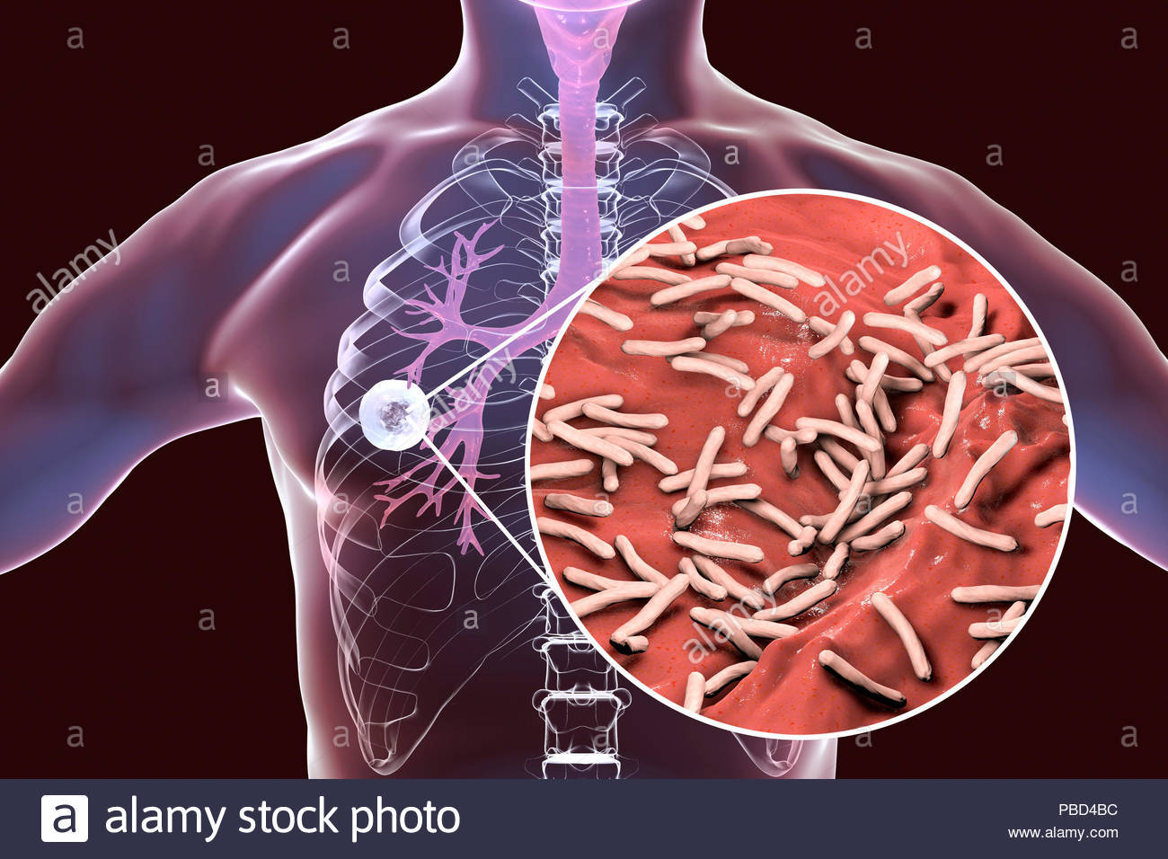 结核分枝杆菌感染肺部