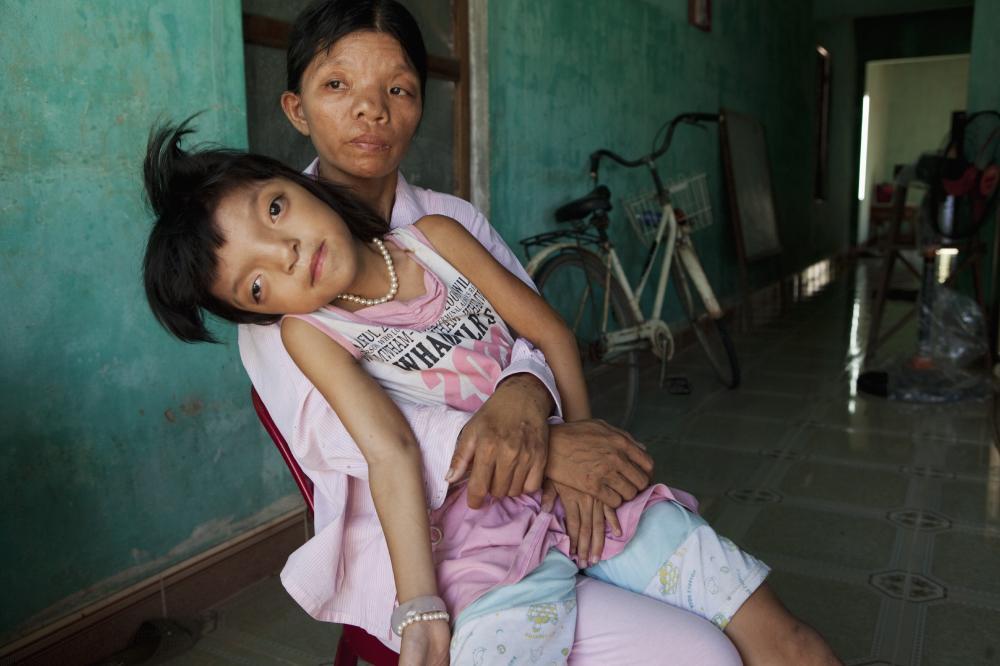 越南橙剂受害者图片图片