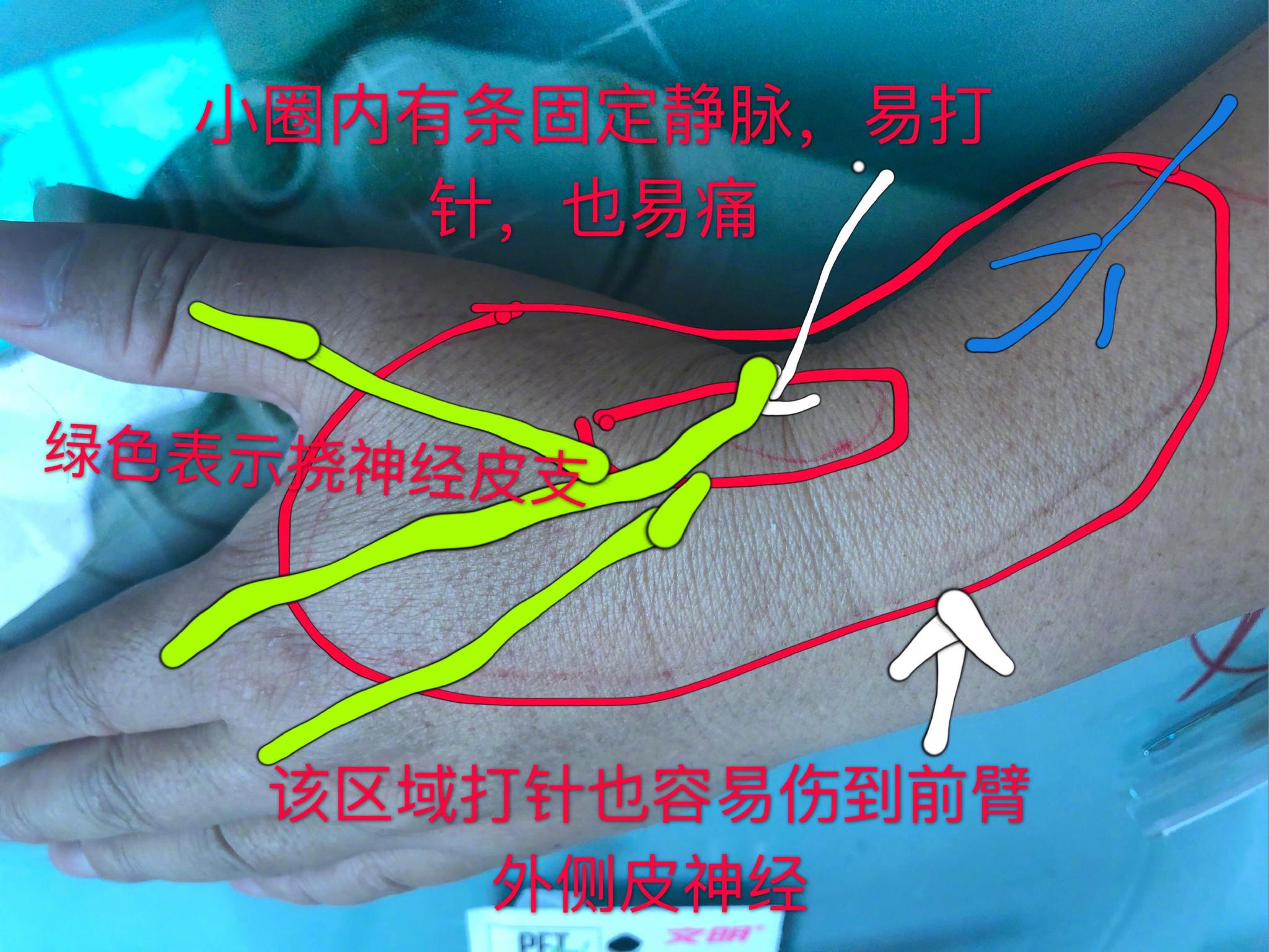 手背上桡神经皮支和前臂外侧皮神经分布的情况