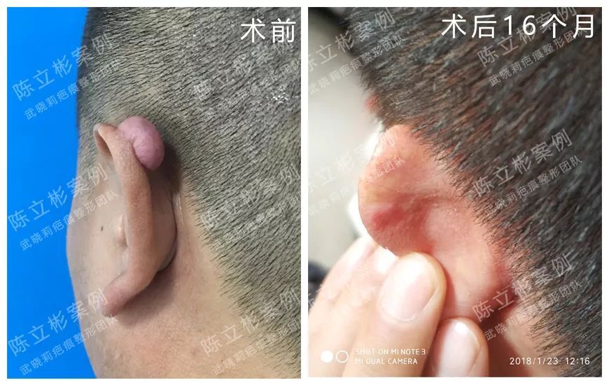 耳部疤痕疙瘩案例解析 