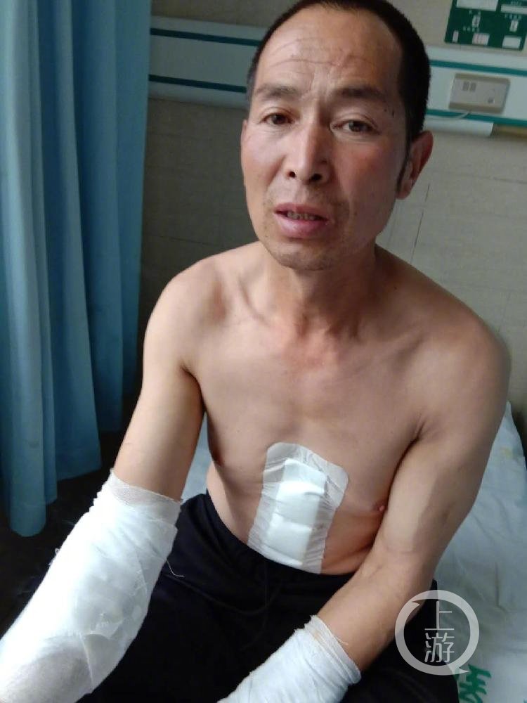小菲父亲王新元胸腹、腿、双臂受伤。受访者供图