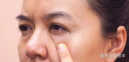 下眼睑手术怎么有效去眼袋细纹？